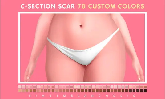 C-Section #2
